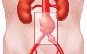 Abdominal aortic aneurysm