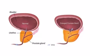 Benign Prostatic Hyperplasia