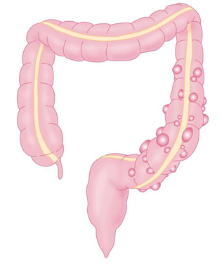 Colorectal Conditions