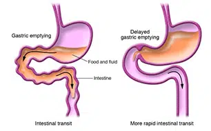 Gastro-intestinal Motility Disorder