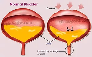Urinary Incontinence