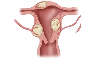 Uterus Medical Conditions