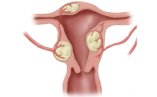 Uterus Medical Conditions